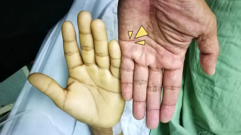 Mengenal anemia aplastik