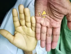 Mengenal Anemia Aplastik, Penyakit yang Diderita Almarhum Babe Cabita